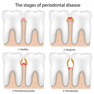 stages of periodontal disease