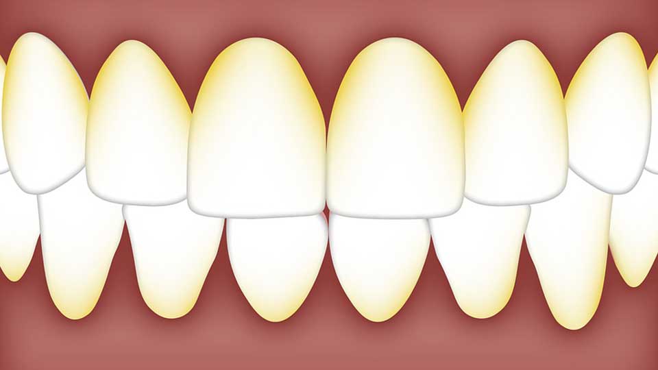 Plaque and Tartar on Teeth: What Are They and How Do You Get Rid of Them?