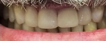 After porcelain veneer treatment at Doug Lewis Dentistry