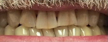 Before porcelain veneer treatment at Doug Lewis Dentistry